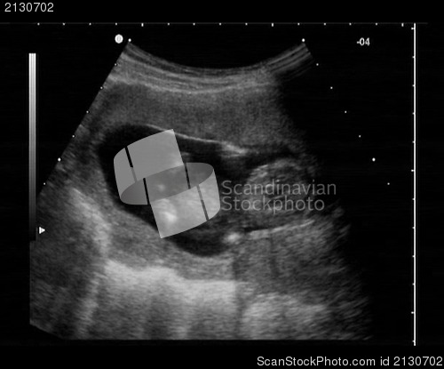 Image of ultrasound fetus