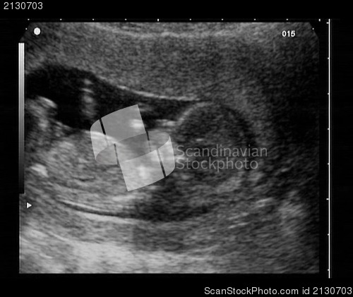 Image of ultrasound fetus