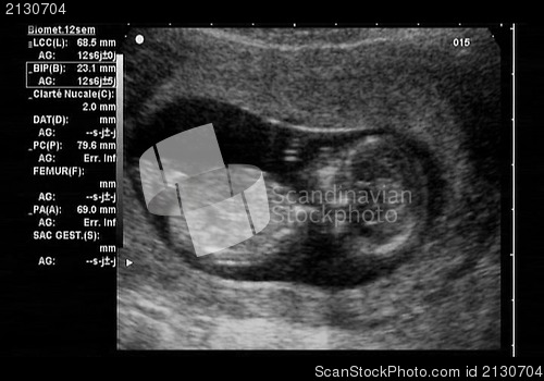 Image of ultrasound fetus