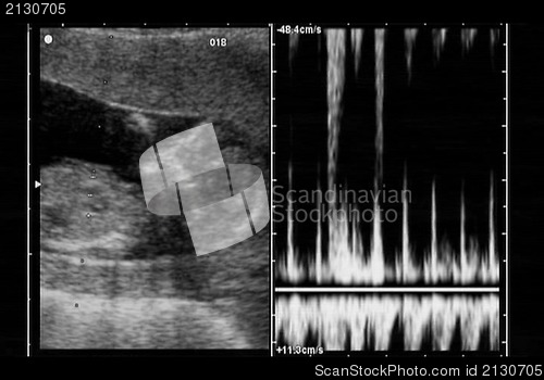 Image of ultrasound fetus