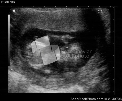 Image of ultrasound fetus