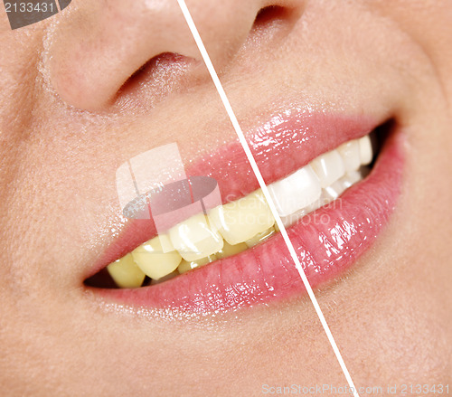 Image of Whitening