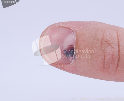 Image of Subungual hematoma under nail
