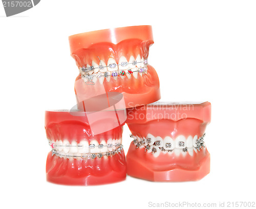 Image of Teeth with braces isolated