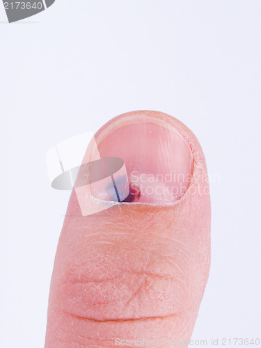 Image of Subungual hematoma under nail