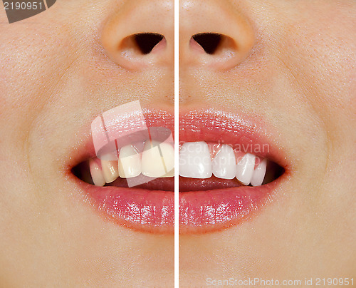 Image of teeth before and after whitening