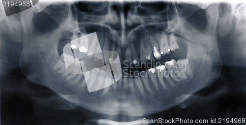 Image of Details of black white X-ray scan of human teeth