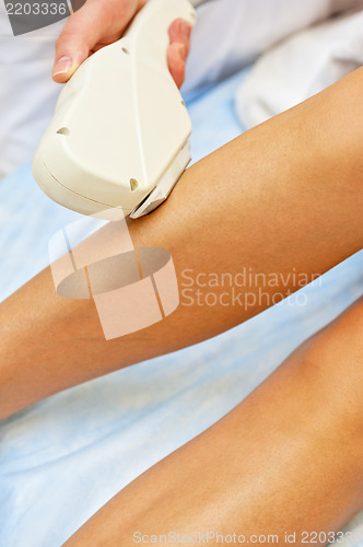 Image of laser epilation