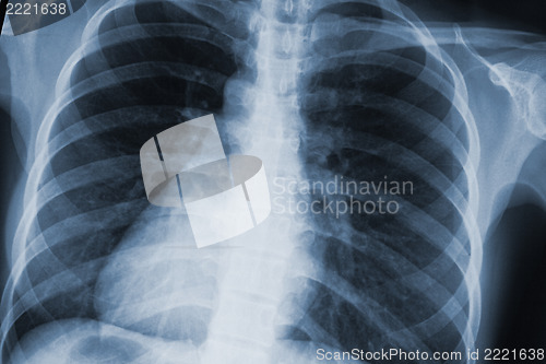 Image of chest xray scan