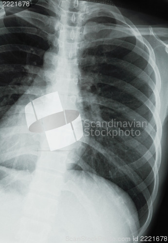Image of chest xray scan