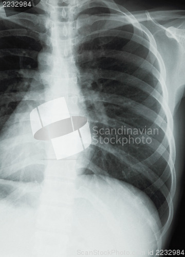 Image of Chest xray scan