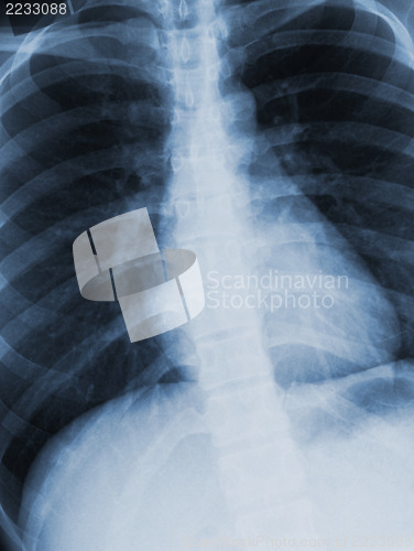 Image of Chest xray scan