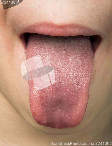 Image of Human tongue protruding out