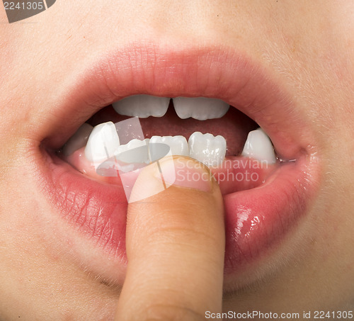 Image of Child shows tooth