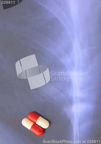 Image of Lungs infection-monotherapy