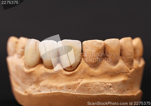 Image of dental impression