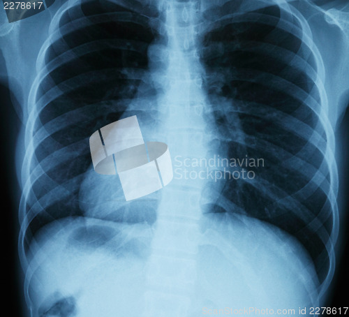 Image of Chest xray scan