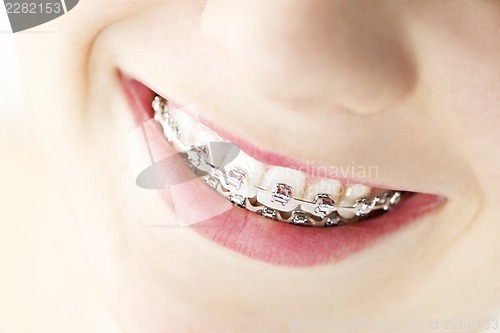 Image of Smile with braces