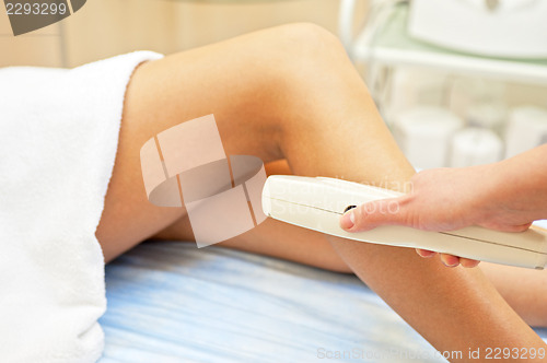 Image of laser epilation