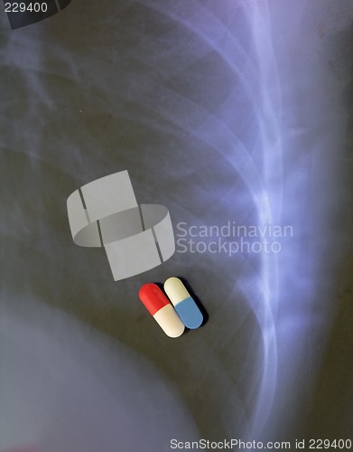 Image of Lung infection combined therapy