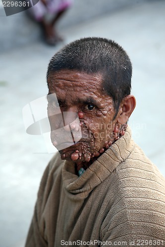 Image of Streets of Kolkata. Portrait of sick man