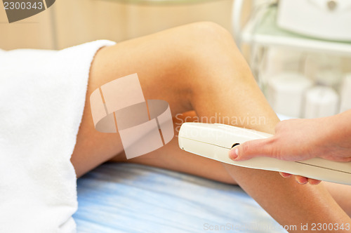 Image of laser epilation