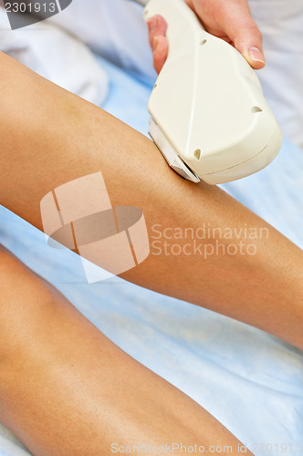 Image of laser epilation