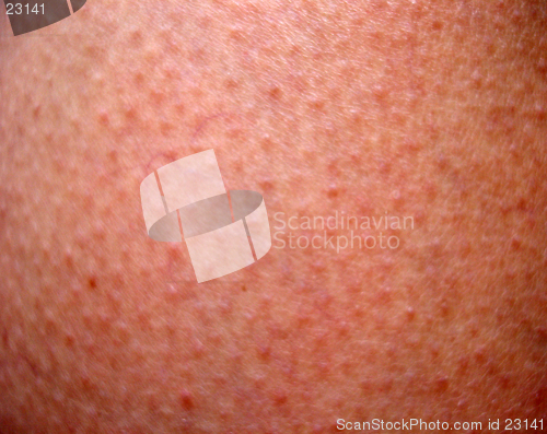 Image of Sunburn