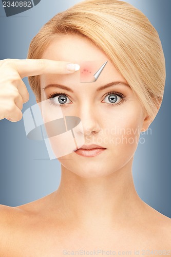 Image of no more acne