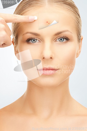 Image of no more acne