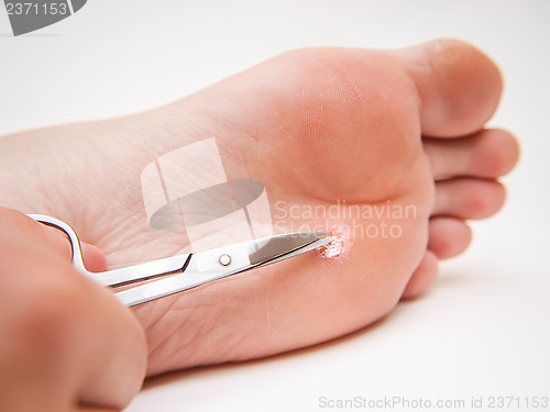 Image of Callus under foot