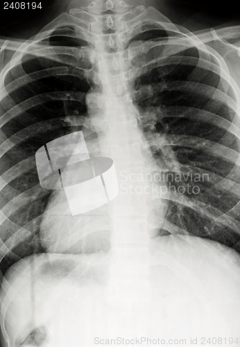 Image of Chest xray scan