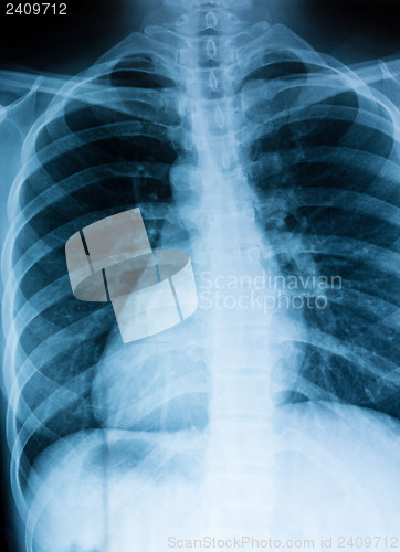 Image of Chest xray scan