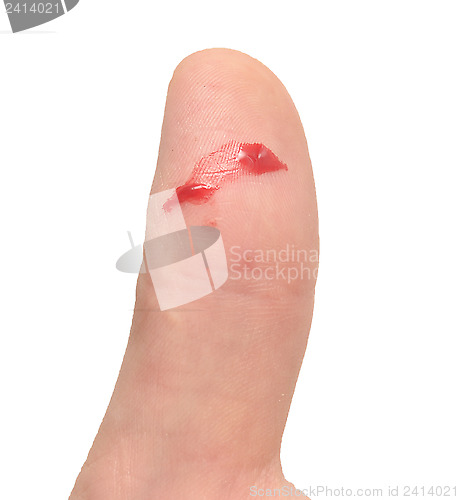 Image of finger with blood
