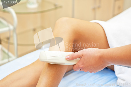 Image of laser epilation