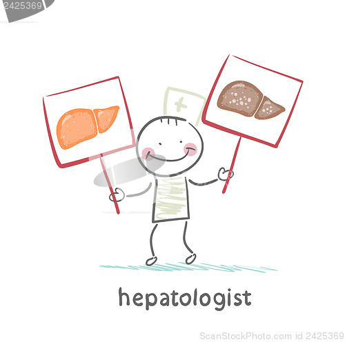 Image of hepatologist holding signs with healthy and diseased liver