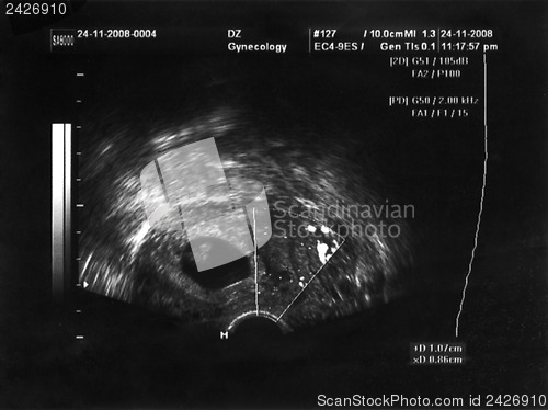 Image of ultrasound fetus portrait