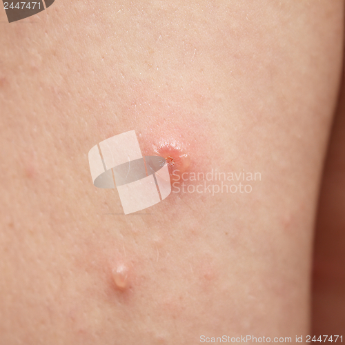 Image of chicken pox blotch