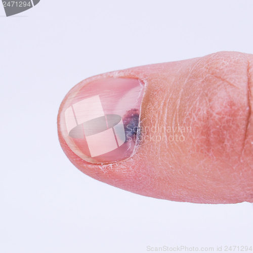 Image of Subungual hematoma under nail