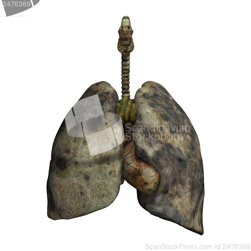 Image of Lungs of Smokers