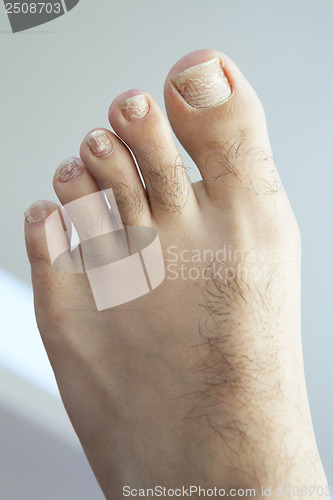 Image of Cracked Fungus Toenails