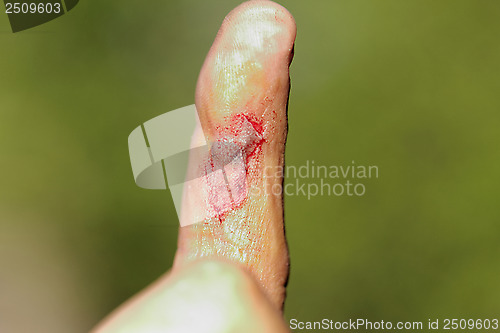 Image of wound on male finger