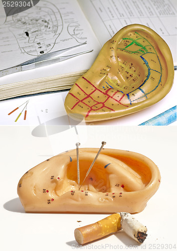 Image of Acupuncture to stop smoking