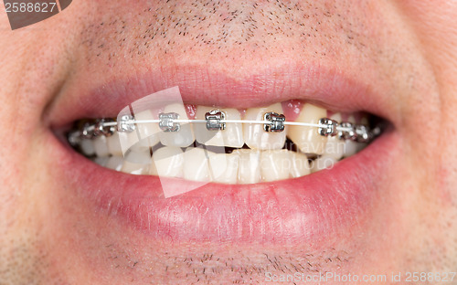 Image of smile with braces on teeth