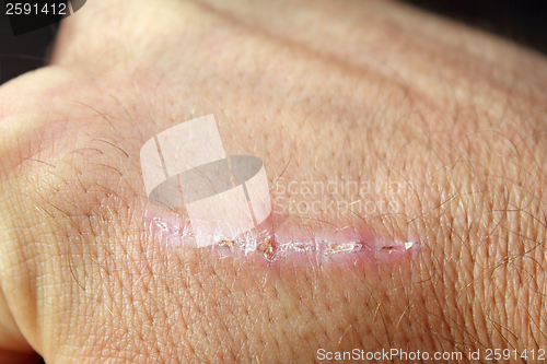 Image of scar on man hand