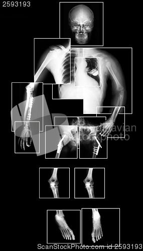 Image of X-ray of lungs