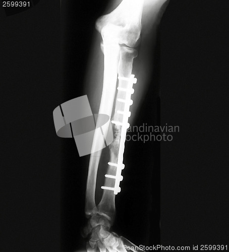 Image of X-ray of Forearm