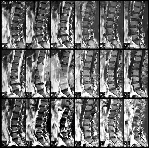 Image of x ray of spine