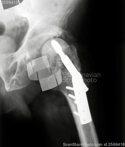 Image of X-rayed Hip