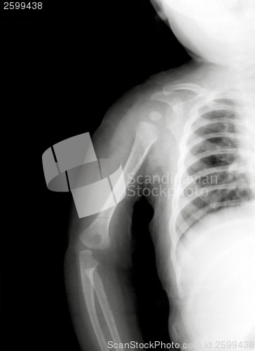 Image of Kid shoulder